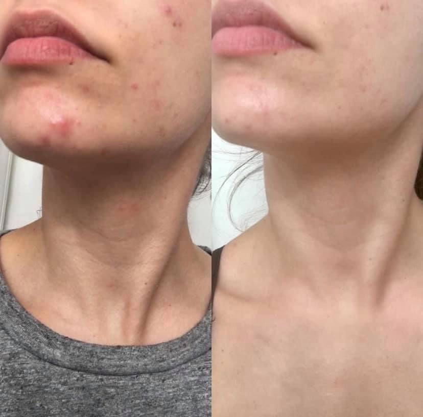 Acnedote Maximum Strength Face & Body Scrub for Acne Treatment, Blackhead Scrub, 8 Oz